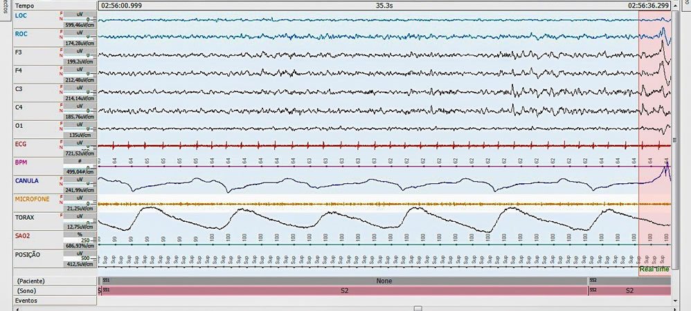Exame do Sono, Polissonografia em Clínica Neurológica de Americana - SP